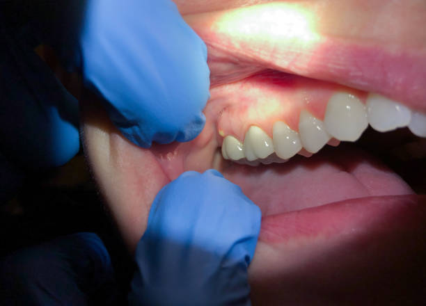 Best Emergency Wisdom Tooth Extraction in St Peters, MO