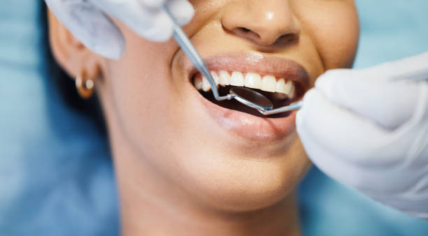 Best Knocked-Out Tooth (Avulsed Tooth) Treatment in St Peters, MO